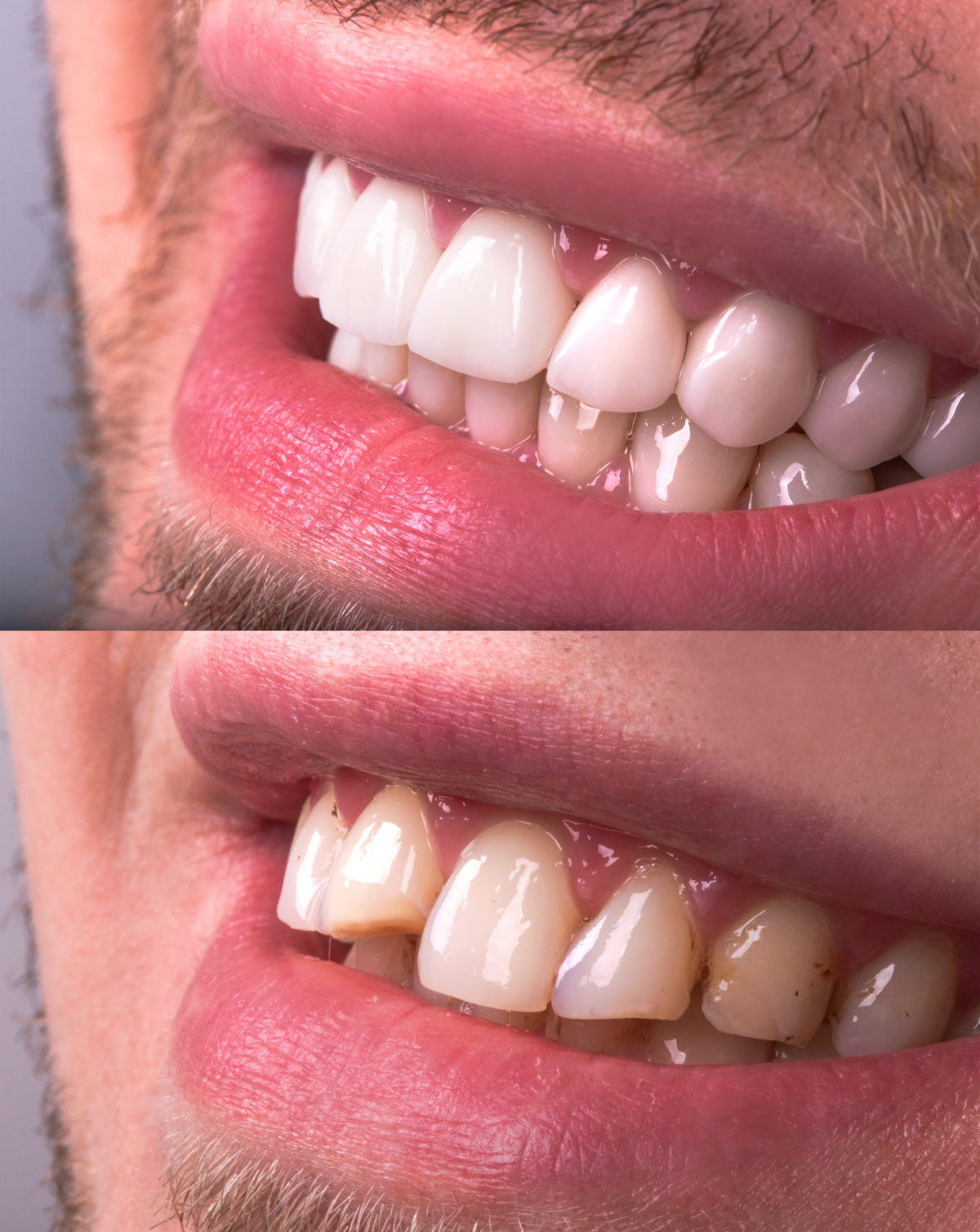 Veneers Skyline Dental Bend Oregon